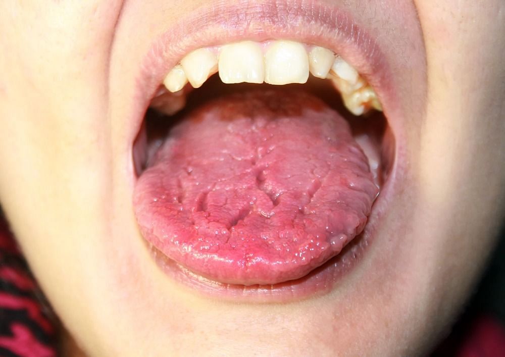 Xerostomia (Image via Getty Images)